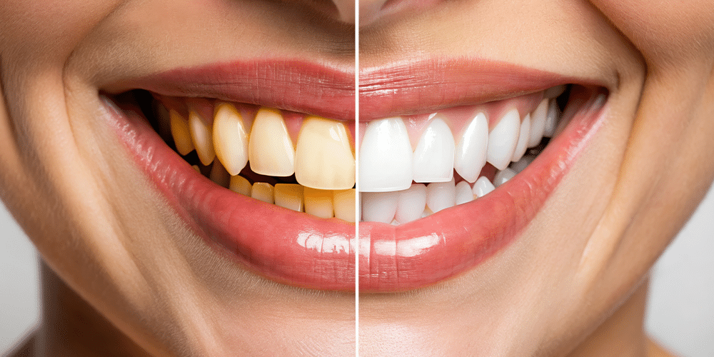 Teeth Whitening Comparison